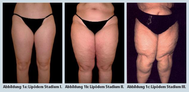 lipoedemastages