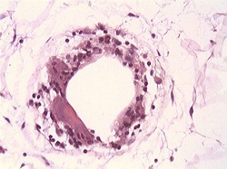 Lipedemic fat cell surrounded by Macrophages
