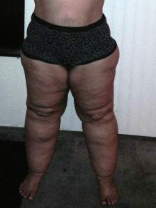 lipedema_front_stage2early3