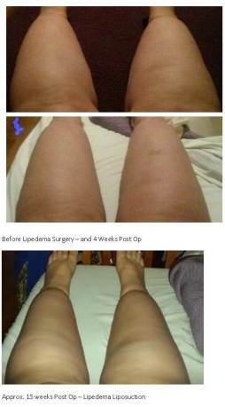 Lipedema Liposuction (Before and After - 3 months)